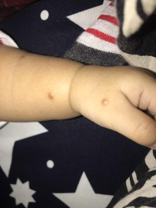 Bintik di tangan si kecil