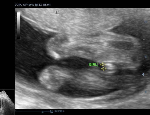 Gender scan