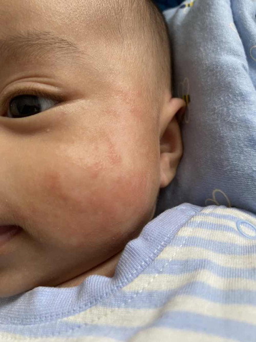 Usia mau 3 bulan pipi masih ruam ruam