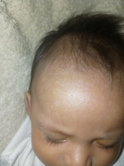 Tanong lang po natural lang po ba na may puti sa noon si  baby 2 months na po sya