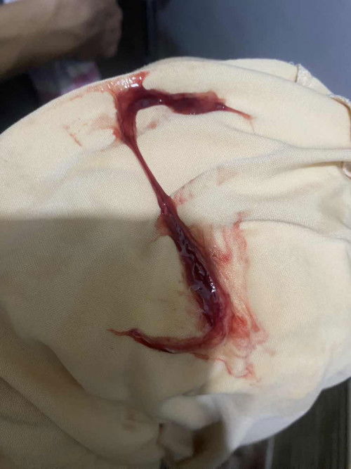 DISCHARGE OR MUCUS PLUG?