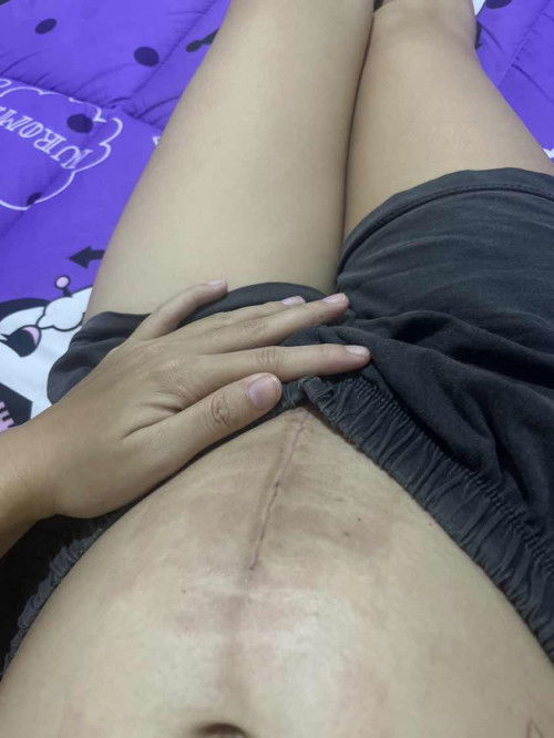 ผ่าตัดซีสต์ขณะตั้งครรภ์