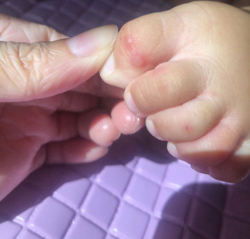 Bintik merah pada kulit bayi