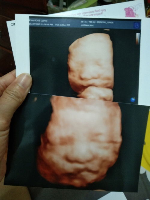 Apakah hasil usg 3d&5d selalu nya akurat ya gak bunda di janin 28week
