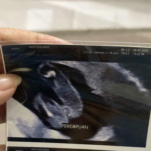usg jenis kelamin saat 17 week