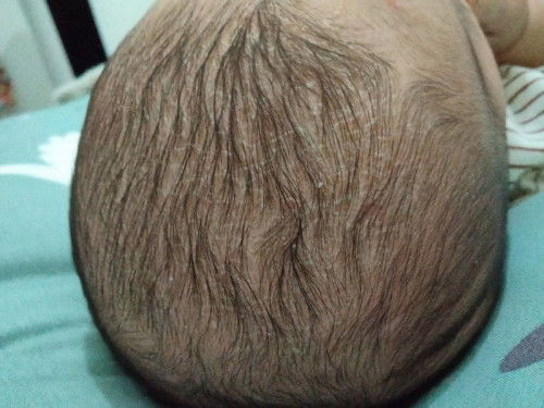 Kulit kepala bayi kering