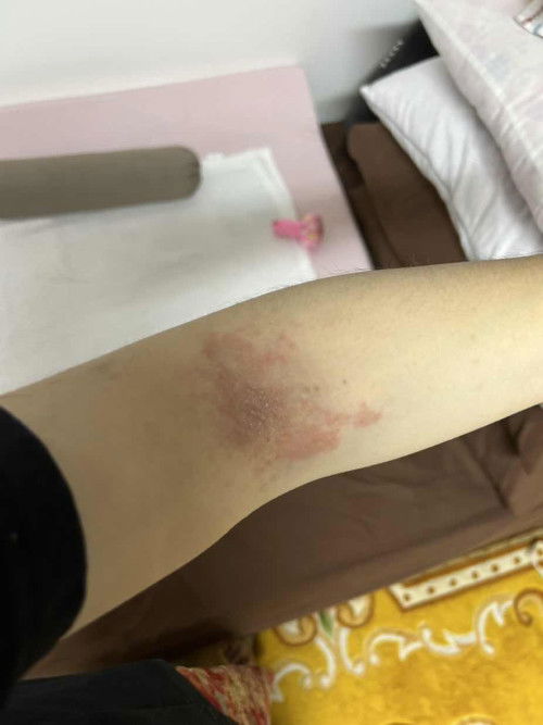 Bintik/ Ruan merah gatal pada ibu