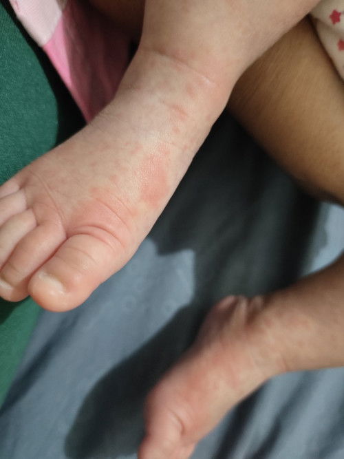 Ruan di kaki dan tangan bayi
