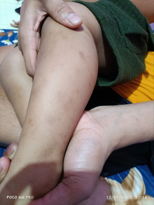Bun saran dong sabun/salep/krim buat ilangin bekas gigitan nyamuk yg menghitam