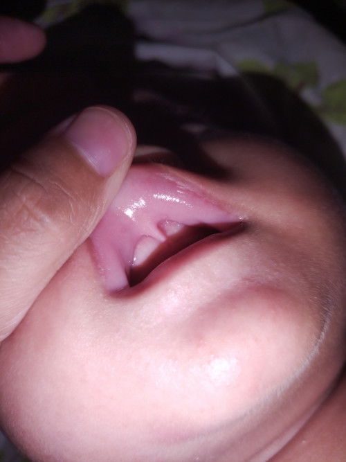 Hello po tanong ko Lang po Kung ito po ba Yung tinatawag nilang Lip tie? 🥺
