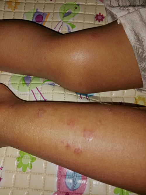 Panik bun, anakku tiap malam gatal2. Gatau ini apa yaa...