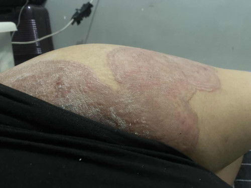 Skin Fungal Infection