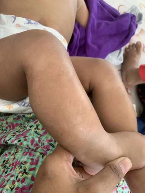 suggest something for moist baby leg  💔