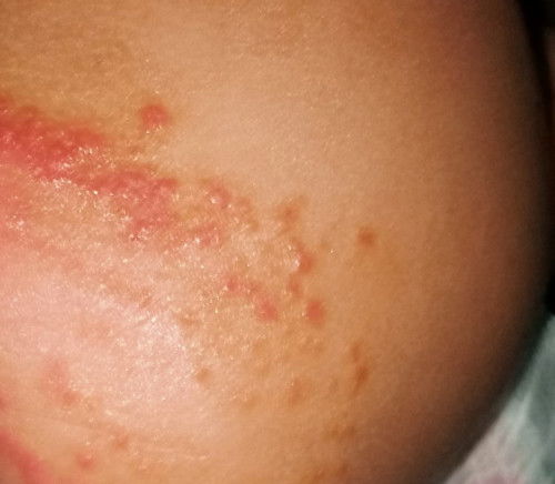 Ano po kaya maganda at epektibong pantanggal ng rashes?  8 months po. Salamat po sa matinong sasagot