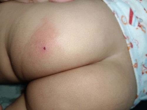 Insects bite kay baby