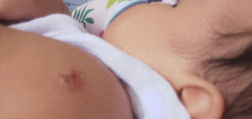 VACCINE BCG