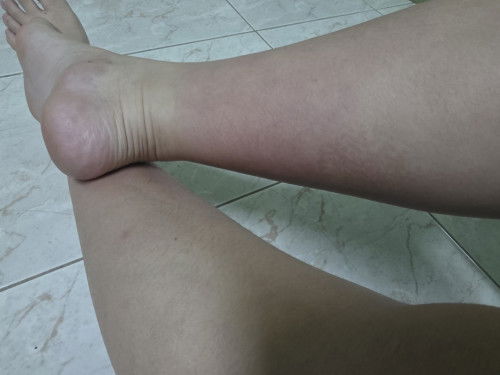 มีใครมีรอยแดงๆที่ข้อเท้าตอนไตรมาสสุดท้ายบ้างไหมคะ