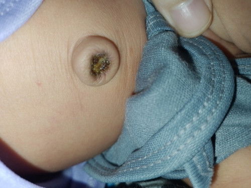 Puser bayi baru lepas tapi masih timbul