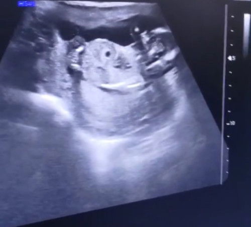 Ano po kayang gender ni baby