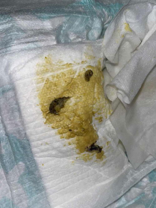 Dark brown mucous-like sa poop