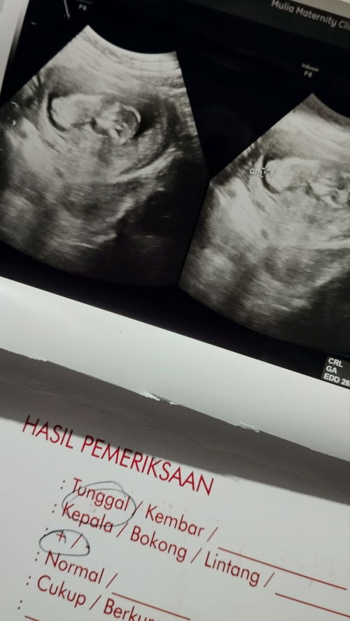 USG 11w5d!