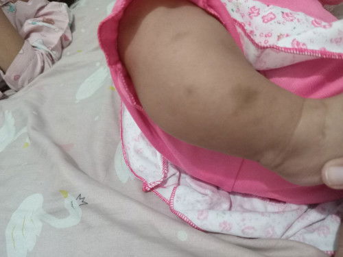 BEKAS GIGITAN NYAMUK