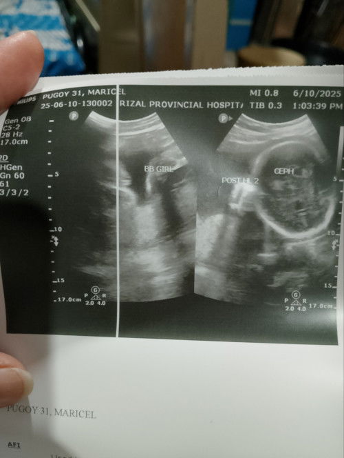 Sino Po Dito marunong mag Basa Ng ultrasound?