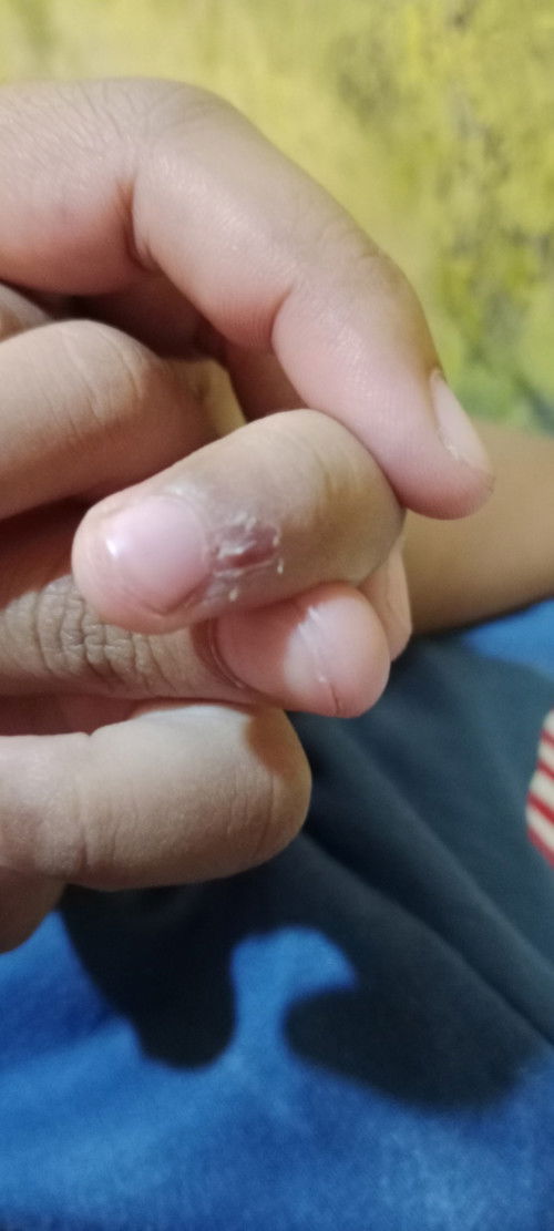Bun mau tanya , ada gak anak nya kulit jarinya terkupas? Gimana biar ilang