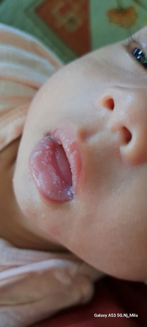 Bibir bayi 1bln 20 hari