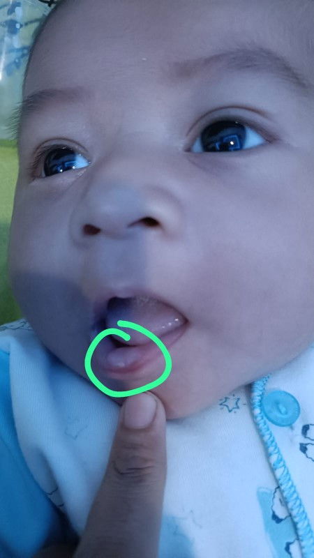 Bibir benjol