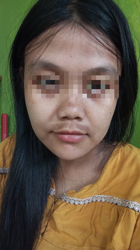 Keluar flek hitam di wajah usia kehamilan 27 Minggu?apakah bisa hilang!!