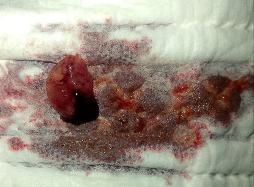Miscarriage po ba to? 😭💔
6 weeks pregnant