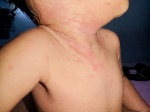 Apakah ada yang pernah anaknya ruam seperti ini?