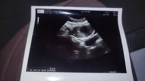 Kehamilan 4 mggu 2 hari, kt dr nya masih imut banget kantung nya Alhamdulillah mudah2an bln de