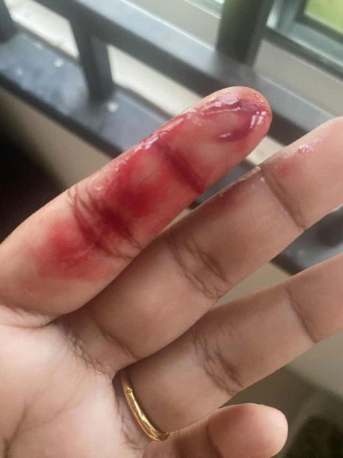 Keluar darah beku tapi tak sakit