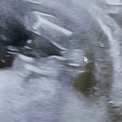 BABY GENDER (14 WEEK +)
