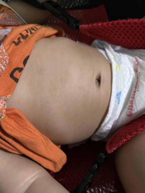Bé nhà e 6t15 ngày bị nổi như này là bị hì vậy các mom , có sao không vậy ạ