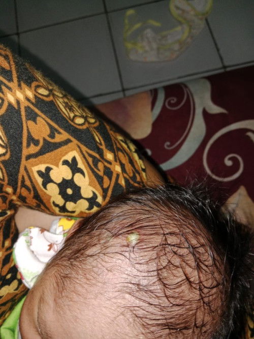 Bayi kena koreng.