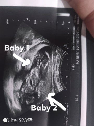 Ask lang Po sinu Po dto may twins pregnancy na nka experience pain lower Ng belly sobng sakit