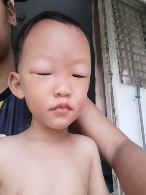 สวัสดีคะ สอบถามแม่คะ 
น้องแพ้ยุง แพ้กัด เป็นแบบนี้นไหมคะ