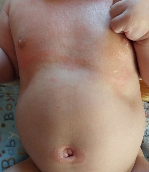 Ruam di badan anak usia 2bln