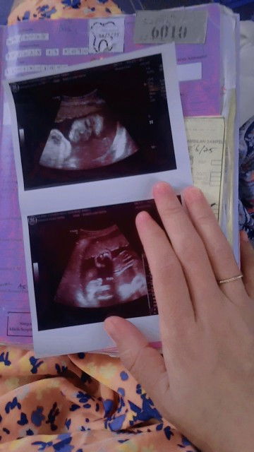 Gambar scan baby,