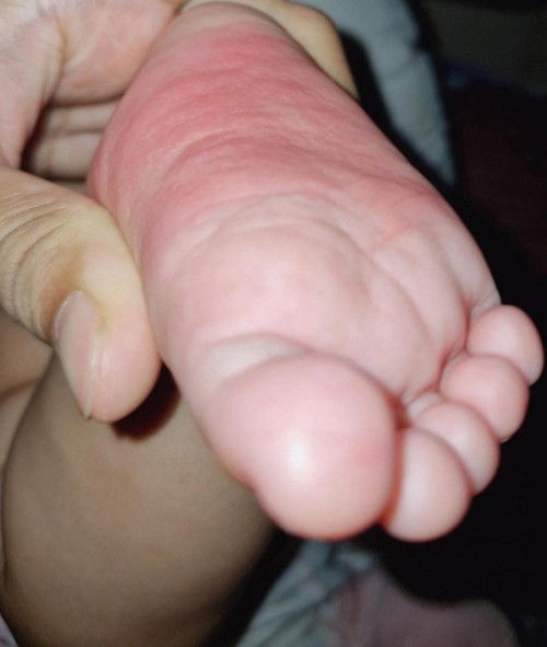 Bintik merah pada bayi