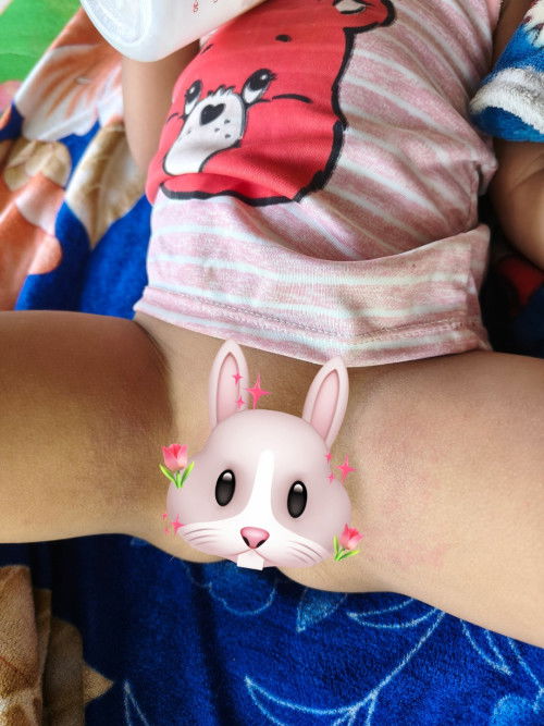 ลูกชายเป็นผื่น