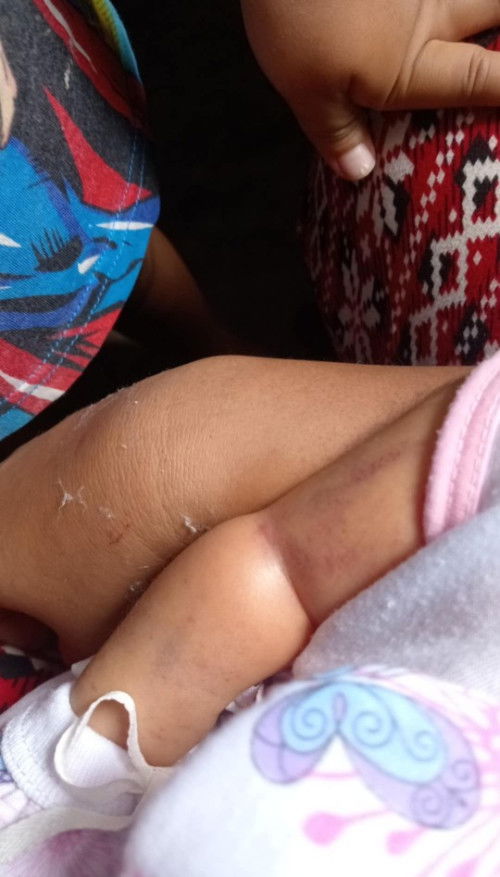Naipit sa balikat nung pinanganak ko