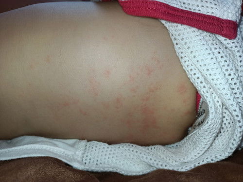 Ruam ke alergik?