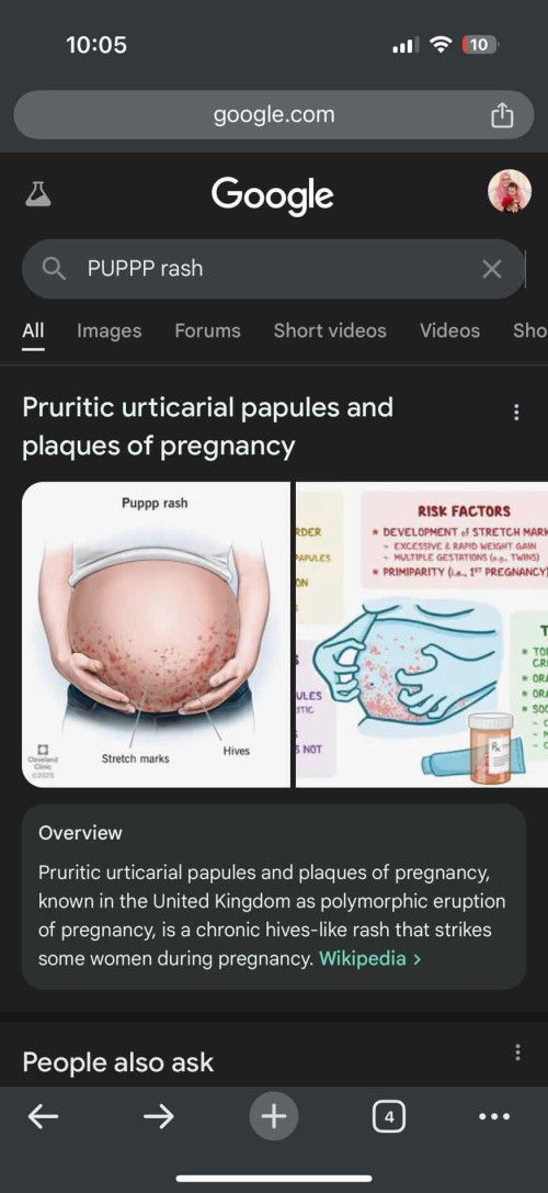 Ruam gatal dekat stretch marks