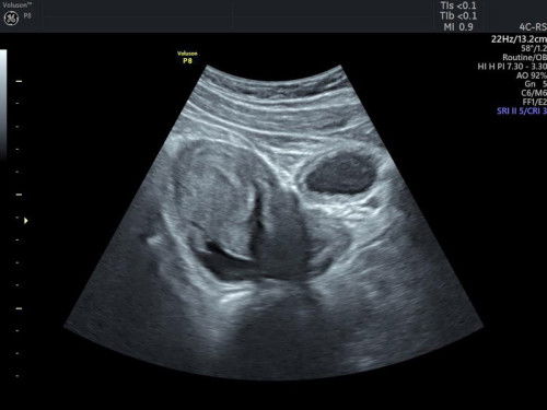 Hpht 17 Juni dan testpack garis 2 tebal