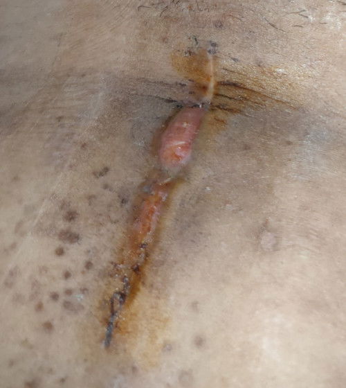 3weeks cs recovery