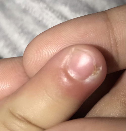 Nail ingrown